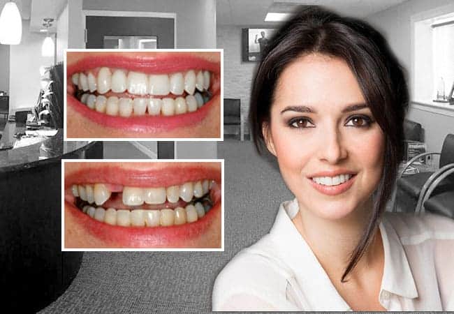 dental implants Abington